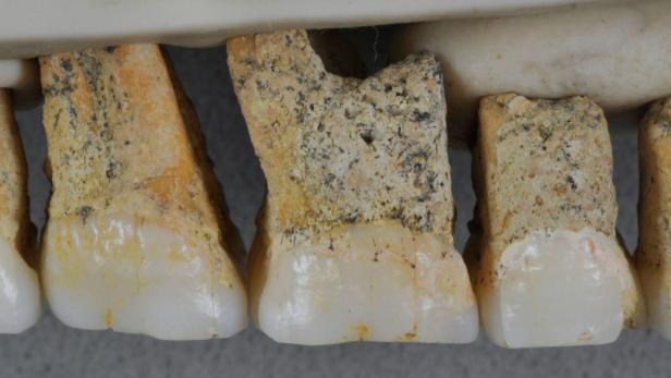 Die rechten oberen Zähne der neu entdeckten Menschengattung Homo Luzonesis.