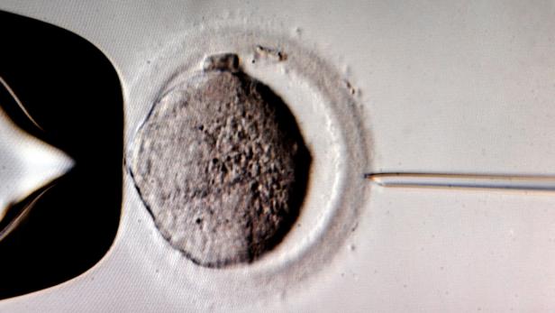 In-vitro-Fertilisation (IVF) Das Baby wurde mittels experimenteller Form von In-vitro-Fertilisation gezeugt.