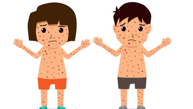 Children has chicken pox infographic, Poster children fever and chickenpox symptoms and prevention. Health care cartoon character vector illustration.