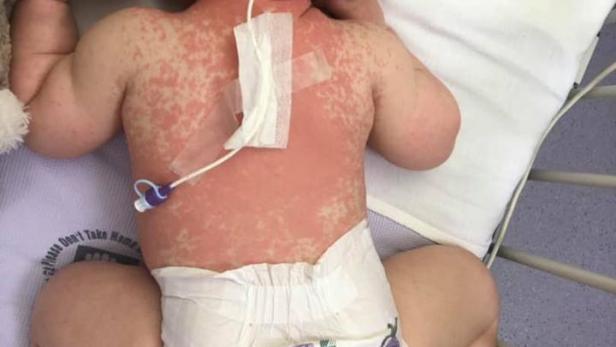 Warnung vor Masern: Mutter teilt Fotos von erkranktem Baby