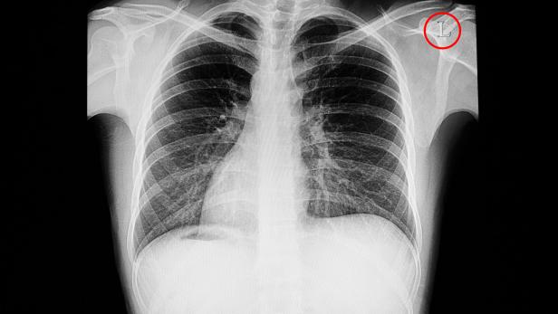 Am Röntgenbild eines Situs invesus sieht man das Herz auf der rechten Körperseite.