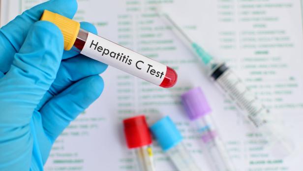 Hepatitis: So könnten Ansteckungen um 90 Prozent gesenkt werden
