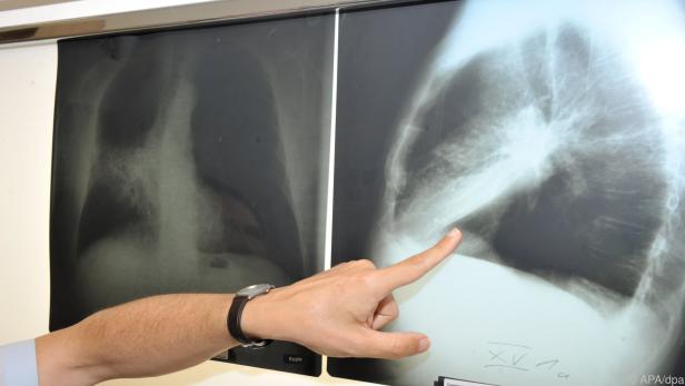 Röntgenbild einer mit Krebs befallenen Lunge