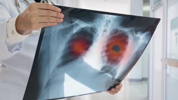 Alarmierende Prognose: Bis 2030 könnte sich die Zahl der Lungenkrebserkrankungen verdoppeln.
