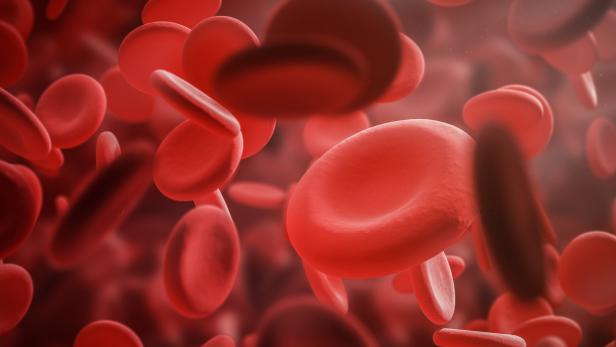 Bei der Patientin war die Bildung des roten Blutfarbstoffes Hämoglobin gestört – jetzt sind ihre Werte normal.