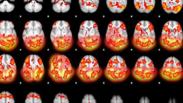 Vergleichende Computertomografie gewalttätiger, depressiver und gesunder Menschen. 