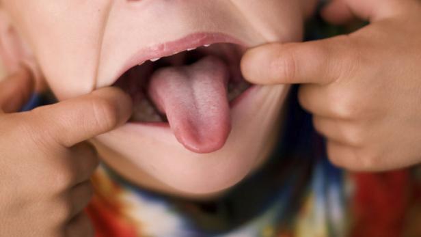Zunge blieb stecken: Wie Ärzte einen Buben retteten