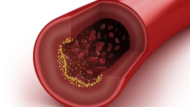 Medikamente gegen Gefäßverkalkung: Wirkung auch gegen Krebs