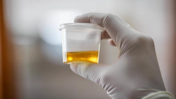 Forscher fanden endlich heraus, warum Urin gelb ist
