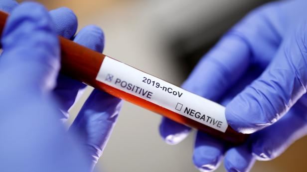 Coronavirus: Wann ist es sinnvoll, sich testen zu lassen?