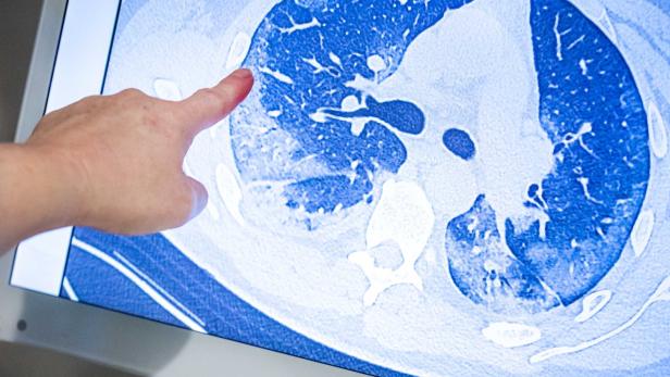 CT-Bild der Lunge eines Covid-19-Patienten: Wolkigweiße Verschattungen in beiden Lungenflügeln als Folge einer starken Entzündungsreaktion.