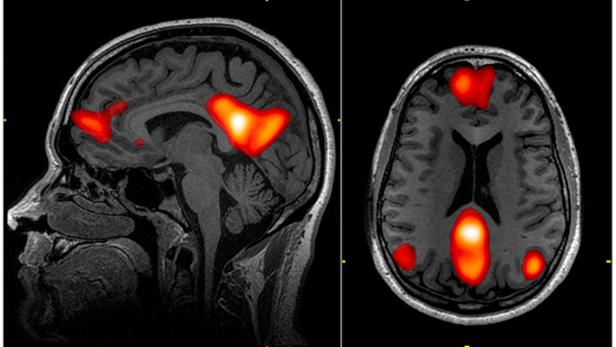 Die Analyse von Gehirnscans brachte unterschiedliche Ergebnisse.