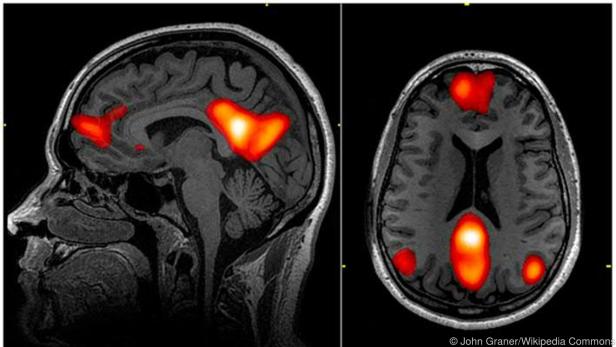 Schädigung des Gehirns: Forscher liefern neue Infos zu Long Covid
