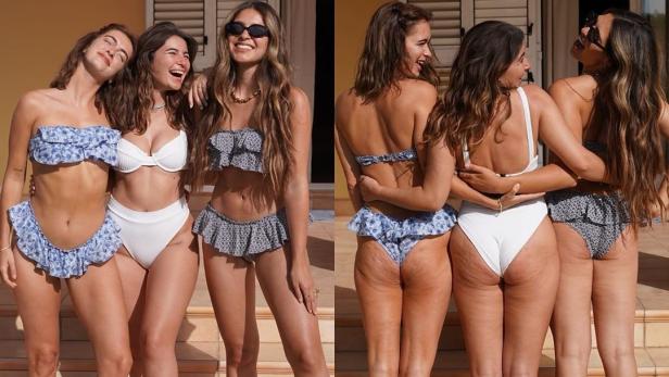 Ungeschönte Fotos: Influencerin will Cellulite normalisieren