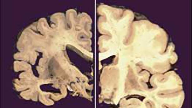 Neue Hoffnung im Kampf gegen Alzheimer