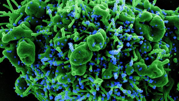 Eine Zelle (grün), die von Coronaviren (blau) infiziert ist.