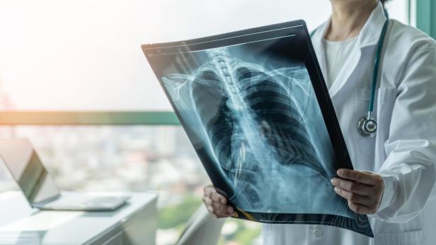 Eine Ärztin betrachtet das Röntgenbild einer Lunge.