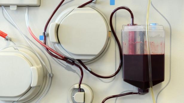 Ein Dialysegerät mit Schläuchen und einem Behälter voller Blut.