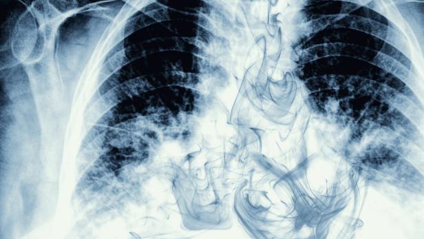 Smoke visible on chest X-ray image