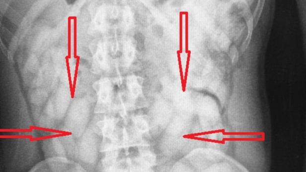 Röntgenbild zeigt abgepackte Drogen im Bauch des Schmugglers
