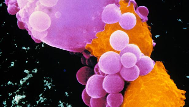 Abwehrzellen (orange) greifen eine Krebszelle (pink) an: Diese beginnt zu zerfallen und sich aufzulösen.