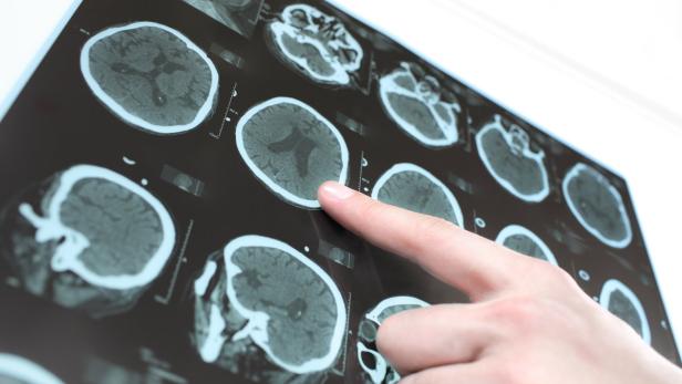 Ein Finger zeigt auf eine Reihe von CT-Scans des menschlichen Gehirns.