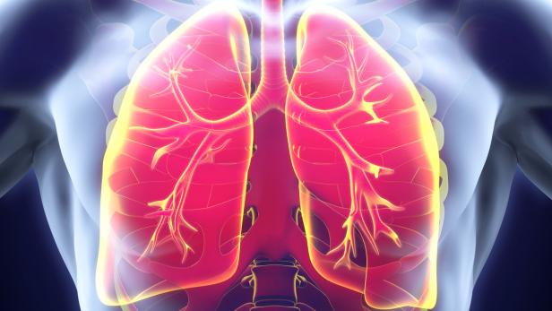 Eine Lungenarterie wird teilweise oder vollständig verlegt