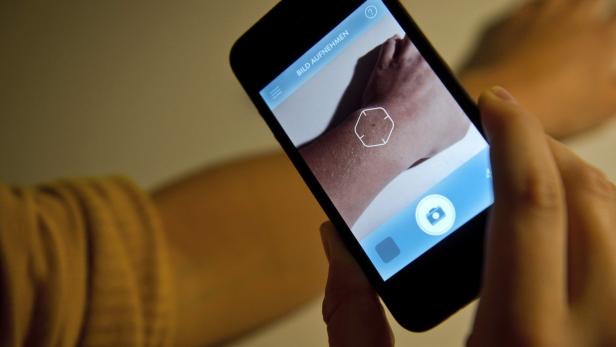 Mit der neuen App &quot;Goderma&quot; werden Fotos von Hautmerkmalen an Fachärzte weitergeleitet.