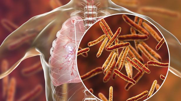 Tuberkulose wird durch Bakterien ausgelöst. Die Erreger befallen überwiegend die Lunge und lösen als erstes Zeichen unter anderem Husten aus.