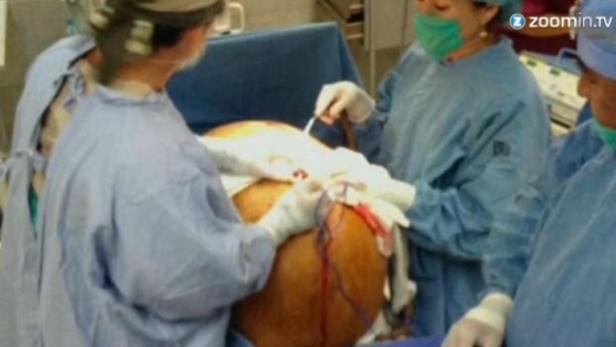 Als sie endlich zu einem Arzt ging, war die Überraschung groß. Ein Team von Spezialisten entfernte den Tumor aus ihrer Gebärmutter. &quot;Es gibt keinen ähnlichen Fall&quot;, sagte der . Das Entfernen des Tumors dauerte vier Stunden.