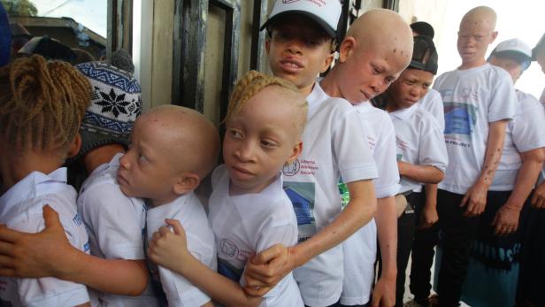 Albinismus in Afrika: Betroffene kämpft gegen Verfolgung und Aberglauben