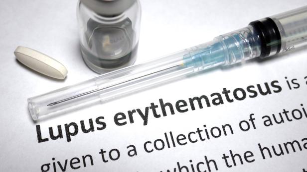 Autoimmun-Erkrankung Lupus: Erste Erfolge mit neuer Zelltherapie