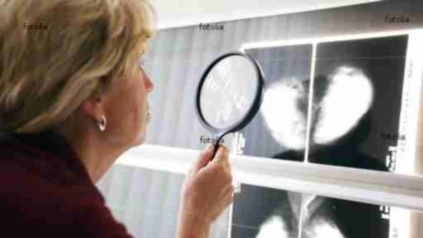 Röntgenuntersuchung der Brust: Mit Hilfe des neuen Programms sollen verdächtige Veränderungen möglichst früh erkannt werden