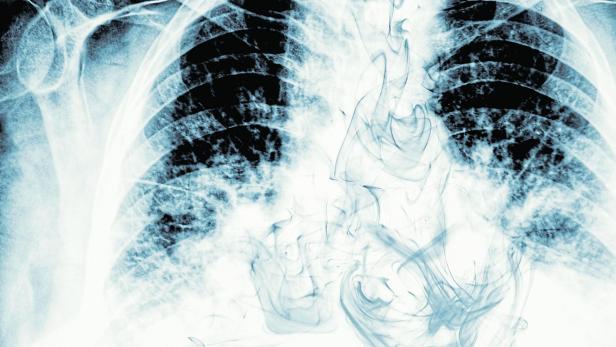 Smoke visible on chest X-ray image