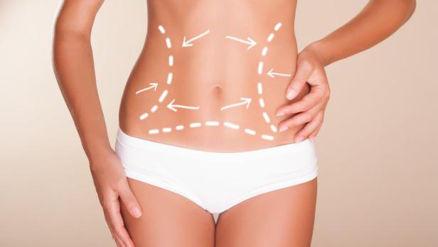 CoolSculpting: Ist die Schönheitsbehandlung riskanter als gedacht?