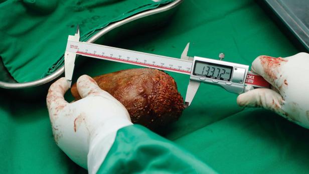 801 Gramm: Weltweit größter Nierenstein herausoperiert