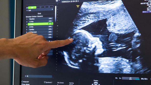 Mit einem Trick kann das Ultraschallbild Aufschluss über das Geschlecht des Babys geben