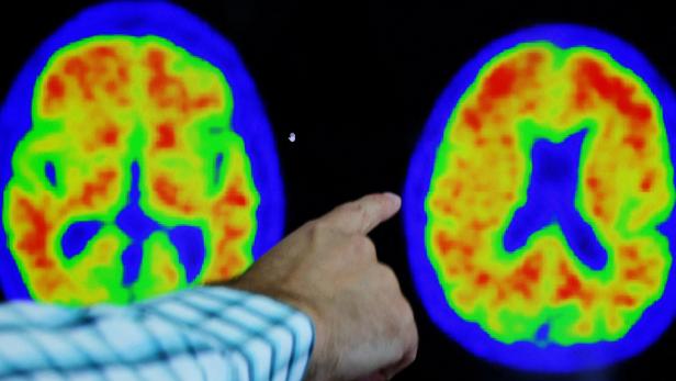 Donanemab, Lecanemab: Was über die neuen Alzheimer-Mittel bekannt ist