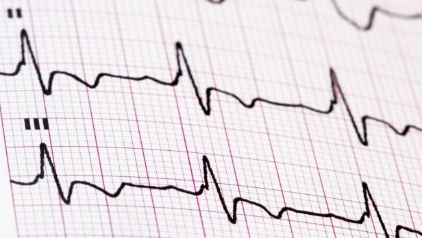 Weniger Herztodesfälle, aber mehr chronische Erkrankungen