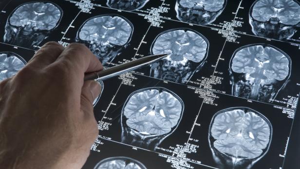 Vom Placebo zu einer möglichen Hoffnung gegen Alzheimer?