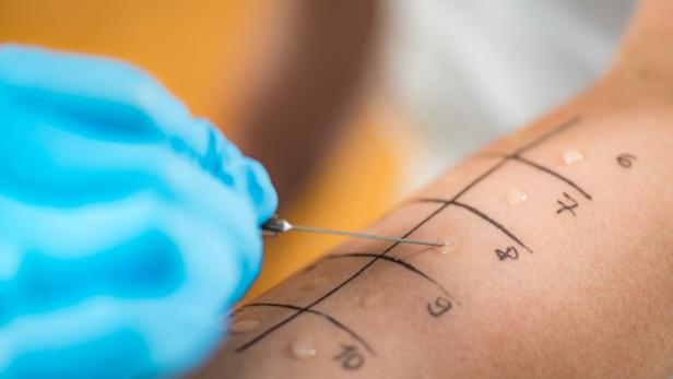 Skin Prick Allergy Testing