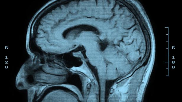 Ein MRT-Scan eines menschlichen Gehirns.