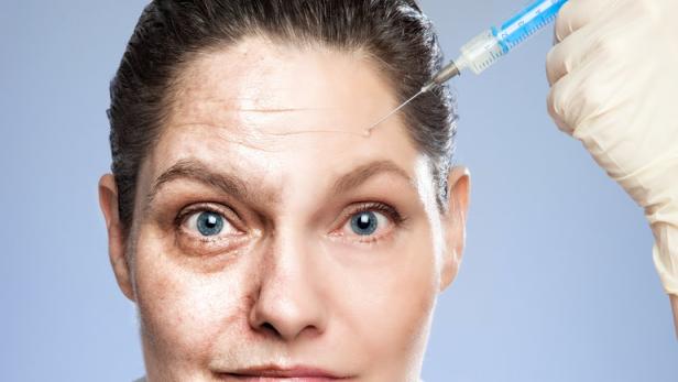 Eine Frau erhält eine Botox-Injektion zur Behandlung von Falten.