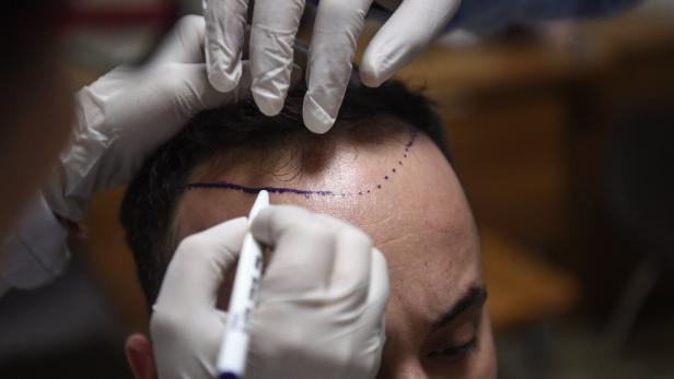Adieu, Geheimratsecken: In Istanbul wird dem Haarausfall der Kampf angesagt.