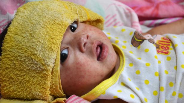 Immer mehr Masernfälle: Fünf Mythen zur Erkrankung und Impfung