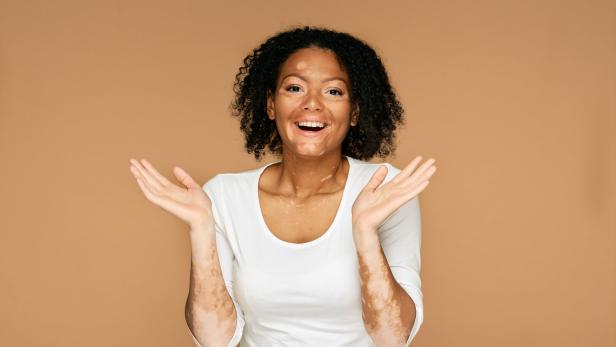Vitiligo: Neue Therapien machen Weißfleckenkrankheit besser behandelbar