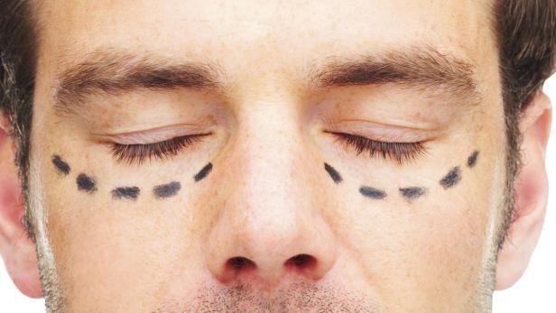 Straffungen der Augenlider gehören zu den Top-5-Eingriffen bei Männern.