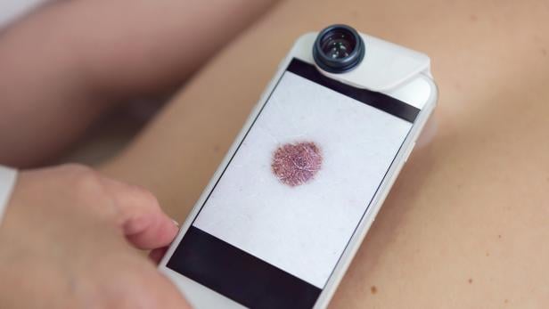 Mit einem Smartphone wird die Haut untersucht.
