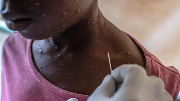 Mpox patients receive treatment in Munigi