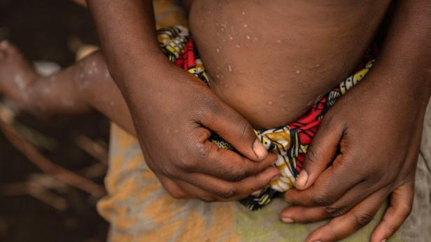 Ein Toter durch Mpox - Behörden melden 28 Fälle